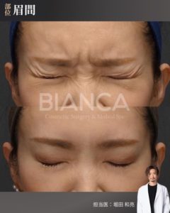 眉間ボトックスの症例写真_正面